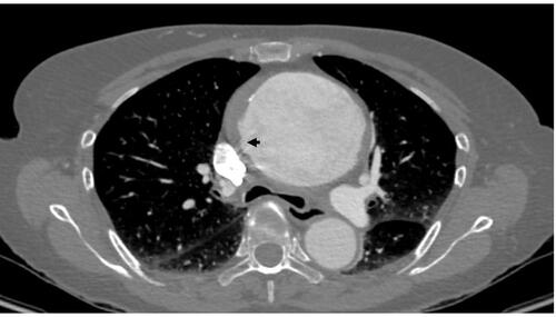 Figure 5 Incomplete dissection with some degree of sub-adventitial hematoma on a computed tomography slice. Notice the intimal tear (arrow).