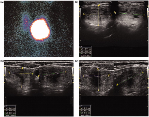 Figure 1. Representative images of: baseline 99mTc thyroid scintiscan (A); ultrasound scan of toxic nodule before laser ablation (B); ultrasound scan 6 months after laser ablation (C); ultrasound scan 6 months after radioactive treatment and 12 months after laser ablation (D).