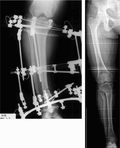 Figure 2. Gradual correction of varus deformity after double-level osteotomy of the tibia with an external fixator (left). The varus deformity was corrected successfully (right).