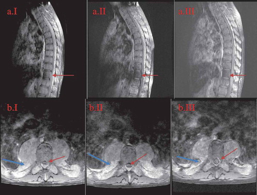 Figure 1. MRI of the thoracic spine in sagittal and axial views at the levels of T6-T7.A = sagittal view; B = axial view; I = initial presentation; II = day 14th after diagnosis; III = week 11th after diagnosis. The regression of the canal stenosis over time from initial presentation to following up can be appreciated on the sagittal view (red arrow) as well as on axial images (red arrow). The reduction of the lesion size can be appreciated on the axial images (blue arrow).