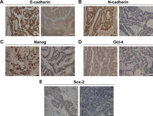 Figure 4 Representative immunohistochemical staining images of EMT and CSC markers in CRC tissues.