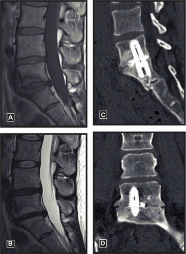 Figure 3 Preoperative T1 (A) and T2 (B) images of a 34-year-old woman with a 6-year history of back pain showing discopathy at the L5/S1 level with Modic 1 endplate changes. Postoperative sagittal (C) and coronal (D) CT at 1 year demonstrates solid fusion.