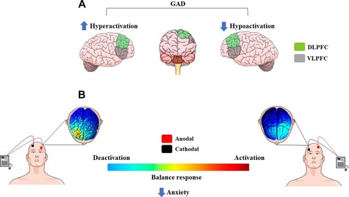 Figure 1 (A) Schematic representation of dysfunctional cortical brain regions in anxiety patients: hyperactivation of right and/or hypoactivation of left frontal cortical regions produce negative emotions. (B) Most common used montage of electrode placement for the treatment of anxiety: modulation of brain activity using tDCS (cathode right, anode left) improves anxiety symptoms by regulating the balance of brain activity.