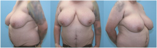 Figure 1. Pre-operative photos of 32-year-old transgender male.