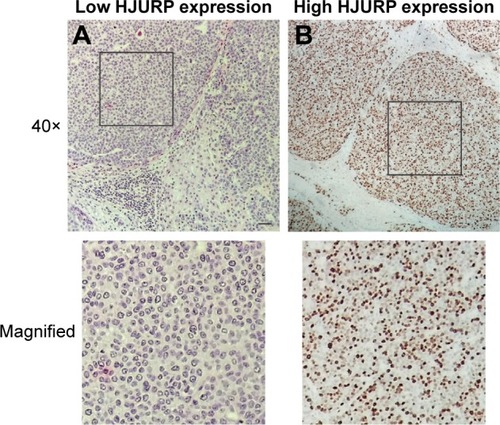 Figure 1 Images of HJURP immunohistochemistry staining. (A) Low HJURP expression and (B) high HJURP expression. Scale bar: 50 μm.