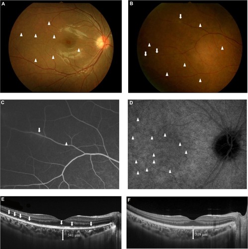Figure 2 Photographs of the right eye in a patient with multiple evanescent white dot syndrome (Case 2) at the initial visit (A–E) and 3 months later (F).