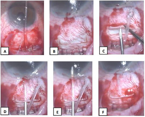 Figure 1 Ahmed Glaucoma Valve Implantation using the LNT technique (A–G). (A) AGV was sutured in place using Vicryl 8–0 and Nylon 9–0 sutures; (B) A 2 (L) × 4 (W) mm scleral flap was created 2 mm anterior to the edge of the plate; (C) G-23 needle was used to create a long needle track; (D) Bevel tip of the G-23 needle near the limbus; (E) Entry of G-23 needle to the anterior chamber parallel to iris plane; (F) Ahmed tube was cut leaving 1–1.5 mm of visible tube inserted in the AC.
