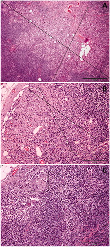 Figure 2. Macrometastasis, micrometastasis, and isolated tumor cells in sentinel lymph nodes of women with breast cancer. (A) H&E section (×40) shows abundant clusters of epithelial cells on a fibrous stroma at an intranodal location. The clusters are larger than 2 mm. (B) H&E section (×100) shows a focus of epithelial cells on a fibrous stroma at an intranodal location measuring more than 0.2 mm but less than 2 mm. (C) H&E section (×100) demonstrates a small cluster of epithelial cells in the subcapsular region. The cluster measures less than 0.2 mm.