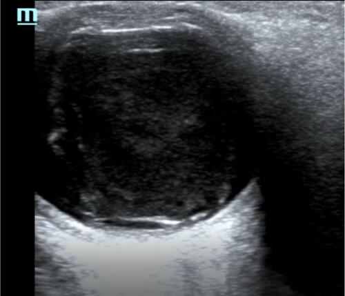 Figure 3 Point of care ultrasound image of vitreous hemorrhage.