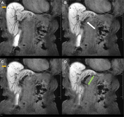 Figure 9 MRCP with Gd-EOB-DTPA.