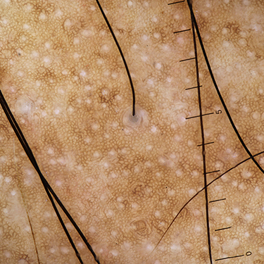 Figure 13 Trichoscopy of lichen planopilaris shows lonely hair sign.