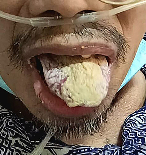 Figure 2 First control - thick plaques still covering of intraoral mucosa and tongue surface of the patient.