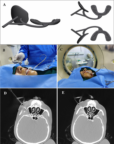 Figure 3 Clinical application of the 3D-PTST. (A) The 3D-PTST viewed from a different angle; (B and C) Use of a 3D-PTST on a patient in a clinical setting; (D and E) The tip of the radiofrequency needle was confirmed by CT. Abbreviations: 3D-PTST, 3D printed Tooth-supported Template.