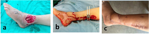 Figure 7 The wound image of typical case 3. (a) preoperation, (b) intraoperation, (c) postoperative day 15. The length, width and depth of the wound are 19.1 cm, 3.3 cm and 0.7 cm, respectively. The area is 63.03 cm2.