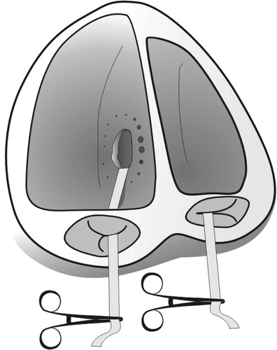 Figure 2. In order to delineate the extent of the defect and its exact location, a cotton band was pulled through the defect from the right to the left atrium.