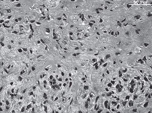 Figure 3.  Case1. Histological appearances of the biopsied specimen demonstrated spindle or polygonal cells with atypical nuclei, eosinophilic amorphous osteoid and matured bone tissue.