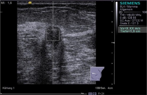 Figure 6 Result of the third attempt to perform ARFI VTTQ of the breast lesion from Figure 4. The orthogonal plane was used, but the measurement was still unsuccessful. This indicated that the SWV exceeded the upper limit of possible measurement (9.10 m/s).