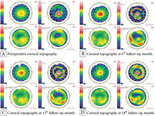 Figure 2. Corneal topography of a 14-year-old female patient with KC: (A) preoperatively; (B) at the 6th follow-up month postoperatively with an improvement in the K readings; and at the 12th (C) and 18th (D) follow-up month postoperatively with stabile K readings.