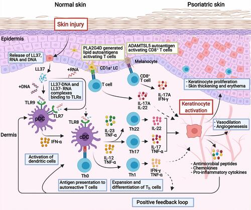 Figure 1 Current concepts of the pathogenesis in psoriasis. In response to skin injury, damaged keratinocytes release LL-37 which forms complexes with self-DNA/RNA. The complexes bind to TLRs and activate dendritic cells, which in turn promote the expansion and differentiation of autoreactive T cells through antigen presentation and secretion of cytokines. IL-23 promotes the differentiation of Th17 and Th22 cells, whereas IL-12 promotes Th1 cells. The activated Th22 and Th17 cells secrete TNF-α, IL-17 IL-22 that stimulate the keratinocytes to proliferate and produce inflammatory cytokines, chemokines, and antimicrobial peptides which further activate immune cells, enabling a positive feedback loop. Other concepts with autoantigens as triggers include; ADAMTSL5 in melanocytes which bind and activate autoreactive CD8+ T cells with subsequent release of IL-17 and IFN-γ; or PLA2G4D producing neolipid autoantigens expressed on CD1a+ dendritic cells, which upon presentation activate lipid-specific T cells secreting IL-17A and IL-22. Created with BioRender.com.