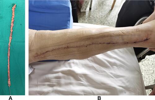 Figure 1 (A) The No-touch great saphenous vein obtained from patients. (B) One week after the great saphenous vein was obtained during surgery.