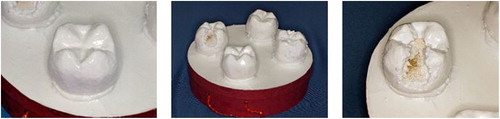 Figure 2. Models of teeth with and without carious lesions.