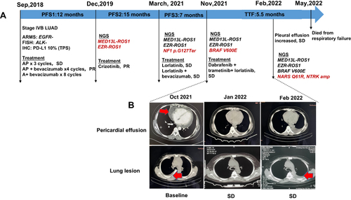 Figure 1 Diagram of patient’s treatment history and clinical course. (A) Timeline of treatment; (B) Change of tumor lesions upon the combined treatment with dabrafenib, trametinib and lorlatinib. The arrow denotes pericardial or pleural effusion; Two months after the treatment beginning, both pericardial and effusions declined; lung lesion remained stable; Three months after the treatment beginning, the arrow denotes the increased pleural effusion, lung lesion remained stable.