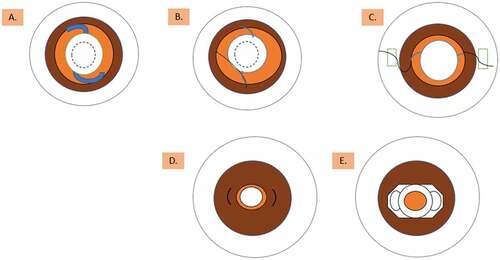 Figure 2. Suitable sites of IOL implantation.