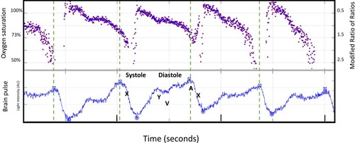 Figure 2 Simultaneous display of the modified ratio of ratios (RRm) and brain oximeter pulse waveform in a single normal animal. The blood oxygen saturation (SO2) and the modified ratio of ratios (right) (Y-axis). The dashed line demonstrates the start of each systole, indicated by the start of the X wave. Systole was temporally associated with a rapid increase in oxygen levels. Thereafter, levels fell during diastole. The lowest oxygen value was at the end of diastole.