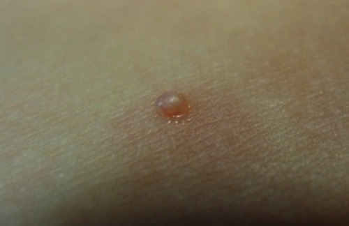 Figure 1 Firm, rounded, skin-colored papules with a shiny and umbilicated surface.