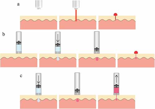 Figure 3. a – Schematic of laser lancing wherein tissue is ablated to create a puncture. b – Schematic of liquid jet-injection wherein a high velocity water jet penetrates into tissue. c – Schematic of liquid jet-injection followed by a retraction of the piston in order to suck blood drawn into the ampoule.