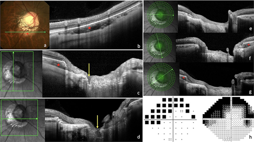 Figure 5 Illustration of a case with correspondence between the locations of Peripapillary intrachoroidal cavitation (PICC), lamina cribrosa defect (LCD), and visual fields defects (VFDs). (a, b, f and g) Red star = PICC. (a) Fundus image showing a severely distorted optic nerve head (ONH). The green arrow indicates the location of section (b). PICC is characterized by the yellow circumscribed appearance at the lower edge of the conus. (b). Horizontal section in the peripapillary zone, along the arrow in (a). (c and d) Vertical (c) and horizontal (d) sections through the ONH along the corresponding green arrows, crossing the same LCD (yellow arrows). (e-g) Radial sections showing the extent of the PICC. Reading clockwise. (e) From 9:00 to 3:00, no PICC. f. PICC disclosed at 5:00. (g) PICC disclosed at 8:00. This PICC extends from 4 to 8:00 clockwise, encompassing the inferonasal and inferotemporal sectors. (h) The corresponding visual field with defects mainly in the upper part of visual field.