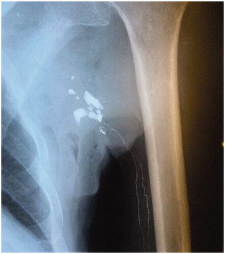 Figure 4. Lymphangiography shows lymph vessels emptying into multiple cavities in the axilla and the lateral thoracic wall.