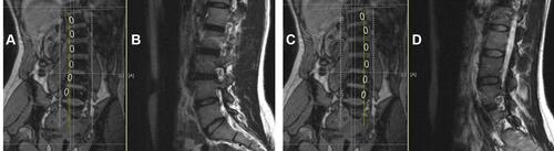 Figure 14 Rot-S demonstrating grossly inconsistent NF evaluation in sagittal sections. (A and C) demonstrates a standard coronal slice in a rotated patient in two different para-pedicular cuts. Note when the standard cut lines (yellow) do not align with the pedicles (white ovals) the sagittal representation of these cut line provides inaccurate NF evaluation through these pedicles (B and D).