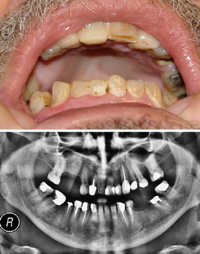 Figure 1. Expanded view of patient's teeth (top) and panoramic radiograph (bottom), showing multiple odontal coronary lesions with loss of hard tissue, missing teeth due to extractions following spontaneous fractures, and multiple dental restorations.