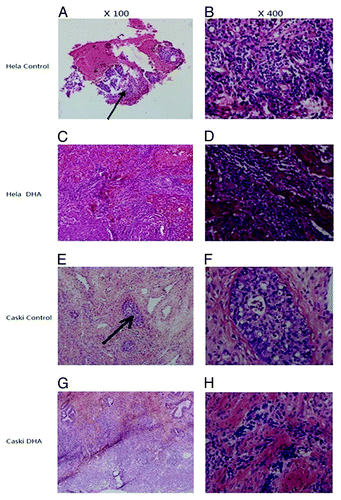 Figure 6. HE staining of tumors in vivo. (A) HE staining of tissue from untreated Hela tumors (100×); (B) HE staining of tissue from untreated Hela tumors (400×); (C) HE staining of tissue from DHA-treated Hela tumors (100×); (D) HE staining of tissue from DHA-treated Hela tumors (400×); (E) HE staining of tissue from untreated Caski tumors (100×); (F) HE staining of tissue from untreated Caski tumors (400×); (G) HE staining of tissue from DHA-treated tumors (100×); (H) HE staining of tissue from DHA-treated Caski tumors (400×). Arrows show focal hemorrhage and necrosis at the center of the tumor in control groups.