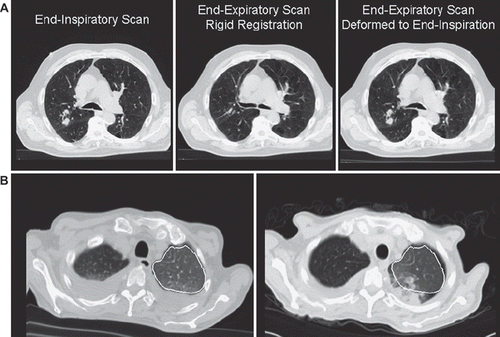 Figure 2. A. Representative example of using deformable registration to account for breathing. B. A unique situation illustrating the limits of deformable registration. The left-sided pleural effusion has resolved, but pneumonitis occurs in the same region. The deformed lung volume (outlined in white) does not include the region of pneumonitis.