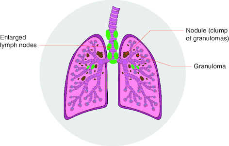 Figure 3. The ways in which sarcoidosis most commonly occurs in the lungs.