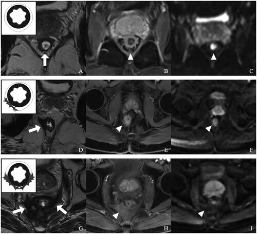 Figure 2. Representative images for distinct perirectal fibrosis score (PFS) values with a schematic diagram (top left corner) based on postoperative rectal MRI. (A–C) PFS = 0. (A) T2WI showing no perirectal fibrosis and adhesion in the peri-anastomotic area (arrow), presacral area and pelvic wall. (B) CE-T1WI showing no obvious abnormal enhancement (arrowhead). (C) There was no significant diffusion-limited high-signal intensity at the perirectal area in DWI (b = 1000 s/mm2). (D–F) PFS = 1. (D) T2WI showing fibrosis and adhesion at the right levator ani Muscle (arrow). (E) In CE-T1WI, the surrounding scar tissue had mild enhancement (arrowhead). (F) DWI (b = 1000 s/mm2) showing no diffusion-limited signal intensity at the fibrosis and adhesion area (arrowhead). (G–I) PFS = 2. (G) Extensive fibrosis and adhesion at the peri-anastomotic area, presacral area and pelvic wall on oblique-axial T2WI (arrow). (H) CE-T1WI showing mild to moderate enhancement in surrounding fibrosis and adhesion tissue (arrow). (I) There was no significant diffusion-limited high-signal intensity at the perirectal area in DWI (arrowhead).