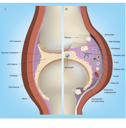 Figure 1. (A) Normal synovial joint and (B) rheumatoid arthritis joint.Reprinted with permission from Macmillan Publishers Ltd: Nature Drug Discovery, © 2003 Citation[1].