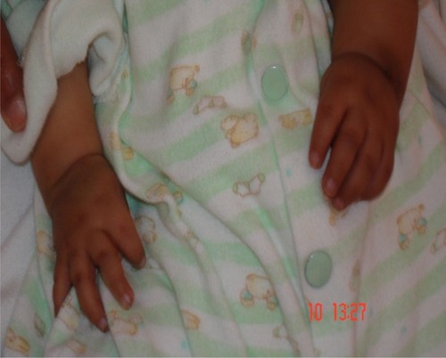 Figure 4 The small hands of a 1-year-old girl with Sanjad–Sakati syndrome.