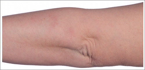 Figure 2. Two months after the initial skin eruption. Clinical examination revealed only residual discoloration and slight induration.