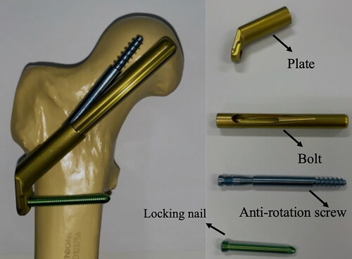 Figure 1. Internal fixation model of the new internal fixation femoral neck system (FNS).