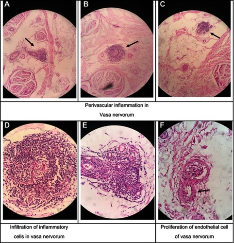 Figure 4 The biopsy obtained from the sural nerve of the amputated limb of a patient with diagnosis of Buerger’s disease.