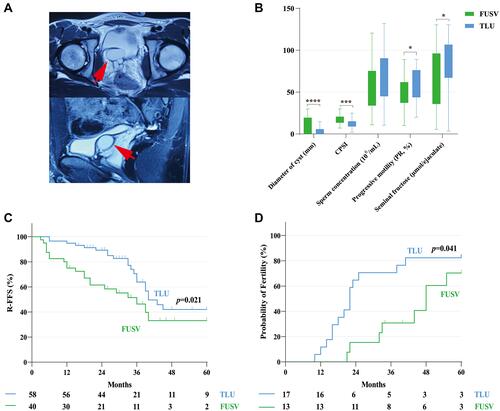 Figure 2 (A) The radiological image of large and symptomatic seminal vesicle cyst (red arrow). (B) Comparison of maximum diameter of cyst, NIH-CPSI score, and semen analysis at 12-month follow-up in patients who underwent TLU and FUSV. Compared with the FUSV group, *, p < 0.05; ***, p < 0.001; ****, p < 0.0001. (C) The Kaplan–Meier curve for R-FFS, and (D) the cumulative incidence of fertility in infertile patients after two procedures (Log rank test, p = 0.021, 0.041, respectively).