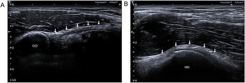 Figure 1 Measurement of coracohumeral ligament and capsule thickness. (A) Coracohumeral ligament. The arrow indicated coracohumeral ligament; (B) Glenohumeral joint capsule. The arrow indicated glenohumeral joint capsule.