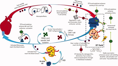 Figure 2. The ‘circle’ of antitumor immune response: Tumor cells grow and dendritic cells have a poor ability to recognize them due to lack of antigenic presentation or inhibitory immune checkpoint molecule expression. RT damage induces radiovaccination, thus enhanced expression and release of tumor specific peptides, chemokine chemoatractive molecules and cytokines activating DCs and Tcells. Primed DCs carrying tumor antigens leave the tumor through peripheral lymphatic vessels and reach the RL. There these activate tumor specific Tcyt that leave the node through the central vein to reach the venous circulation. RT destroys DCs and Tcyt and the overall lymph node structure minimizing the efficacy of the radio-vaccination effect. Moreover, RT kills lymphocytes circulating in the normal tissues included in the RT fields, inducing strong lymphopenia and, further minimizing the radiovaccination effect. Extraction of autologous cancer cells, transduction to secrete cytokines and ex-vivo irradiation build a strong vaccine that can be injected in the efferent lymphatics of DLs, outside the RT portals. ASI reproduces the radiovaccination effect in undamaged lymph nodes that replace the radio-suppressed immune function of damaged RLs. Extraction of Tcells, activation with cytokines or development CAR-Tcells and re-infusion in the venous stream further boost the anti tumor immune cascade. ICIs or cytokines may shft the monocytic popolulation toward anti-tumor phenotypes that leave the bone-marrow to enrich the venous stream. Anti-tumor lymphocytes and monocytes reach metastatic sites to exert abscopal tumoricidal activity, controlling the tumor outside the RT portals. These cell will also reach the primary tumor shifting the post-RT equilibrium toward tumor eradication. ICIs further unmask cancer cells, block regulatory immune cells and allow killer cell activity. Cytokines that specifically prime cytotoxic activity and block regulatory activity may further assist the immunological elimination of the disease. (Green curved arrow: lymphatic circulation; red curved arrow: arterial circulation; blue curved arrow: venous circulation; green straight arrow: enhancement; red straight arrow: inhibition; green +: promotion; red X: blockage; RT = radiotherapy; RL = regional lymph node; DL = distal out-field lymph node; tT = transduction of Tcells; ASI = active specific immunotherapy; Tcyt = cytotoxic Tcell; DC = dendritic cell; LAK = lymphokine activated killer cells; CAR Tcell = chimeric antigen receptor Tcell; ICI = immune checkpoint inhibitors).