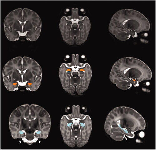 Figure 1. Example of the segmentation of amygdala and hippocampus in a study subject. The amygdala and hippocampus are shown in coronal, axial, and sagittal planes with orange and blue colors respectively.