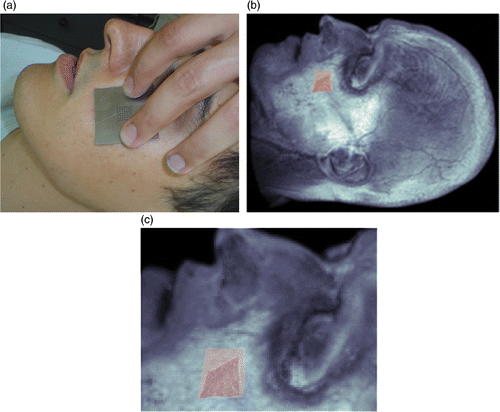 Figure 10. Reconstructed surface is superimposed on the MR surface of the subject.