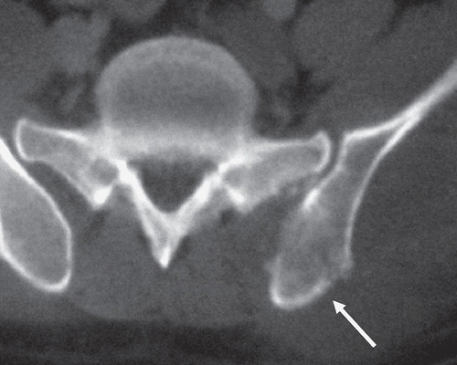 Figure 4.  Case 2. Plain CT showed a lytic lesion in the posterior superior iliac spine (arrow).