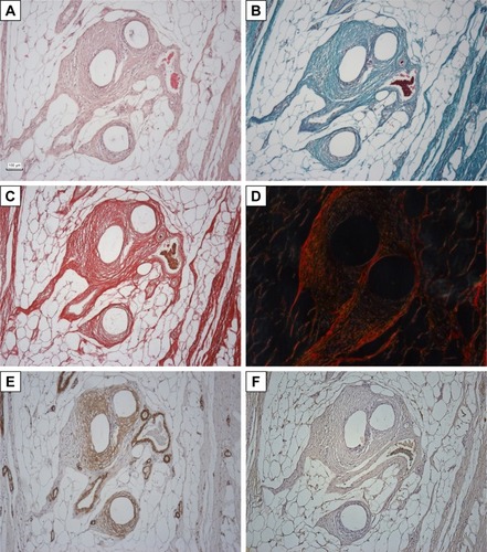 Figure 2 An overview of the staining applied at corresponding areas of histological sections.Notes: (A) Hematoxylin–eosin; (B) Verhoeff’s hematoxylin and green trichrome; (C) picrosirius red in a bright-field microscope; (D) picrosirius red in a circularly polarized light; (E) antibody against smooth muscle actin (myofibroblasts and smooth muscle cells in a vascular wall); (F) CD31 antibody (endothelium of microvessels). Scale bar: 100 μm.